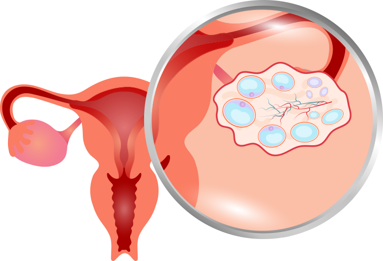 Polikistik Over nedir. Polikistik Yumurta görünümü.